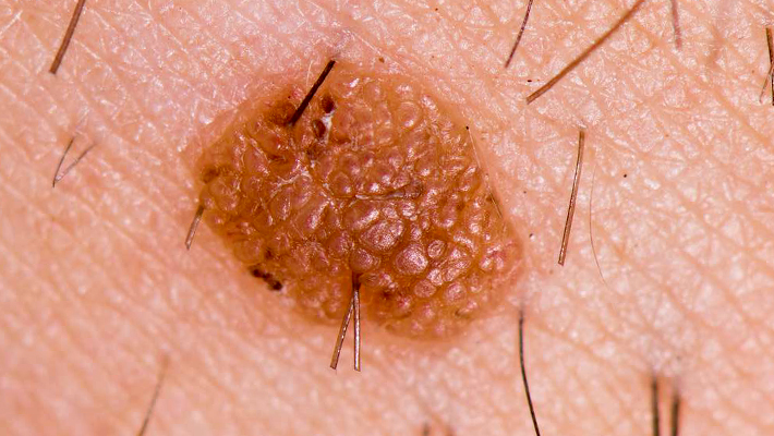 Причины появления кератом и их лечение