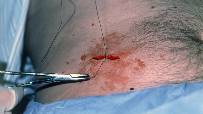 Хирургическое удаление родинки