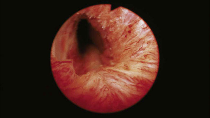 Удаление полипа уретры у женщин