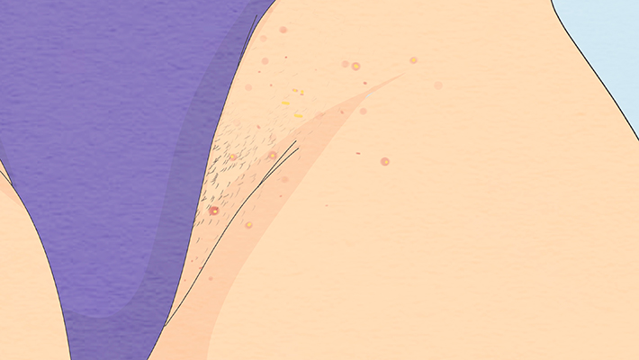 Гранулы Фордайса на половых губах