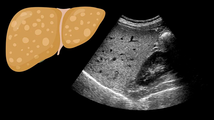Подготовка к УЗИ печени