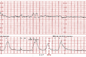 Результаты кардиотокографии