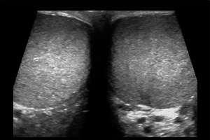 Как делают УЗИ органов мошонки