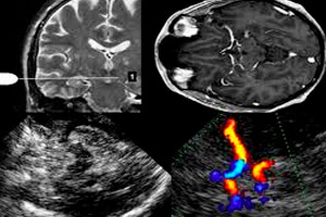 Как делают УЗИ сосудов головного мозга