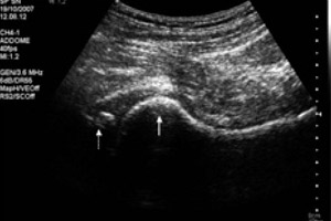Изображение на экране при УЗИ тазобедренного сустава