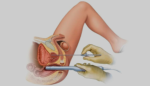 Как берут биопсию простаты у мужчин