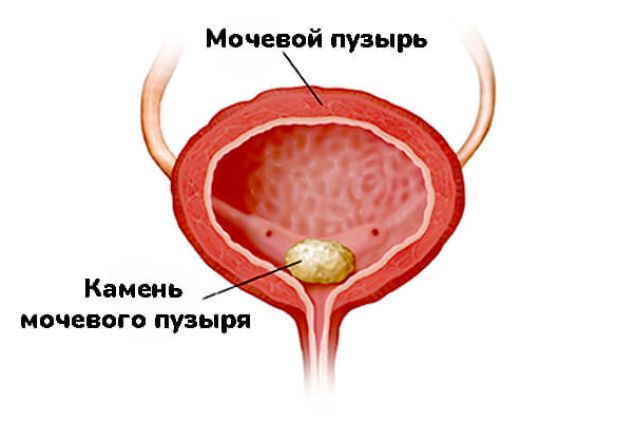 Мочекаменная болезнь