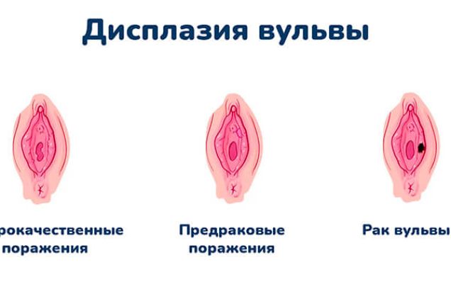 Дисплазия вульвы