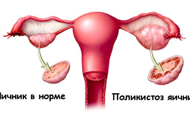 Поликистоз яичников