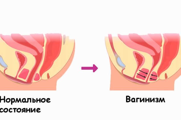 Вагинизм